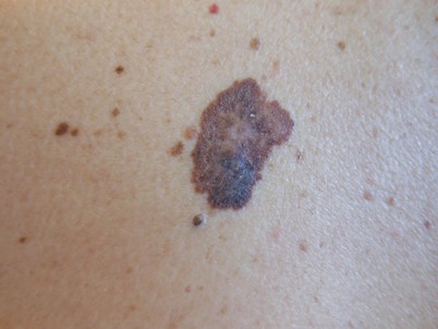 Il melanoma è il più grave dei tumori della pelle